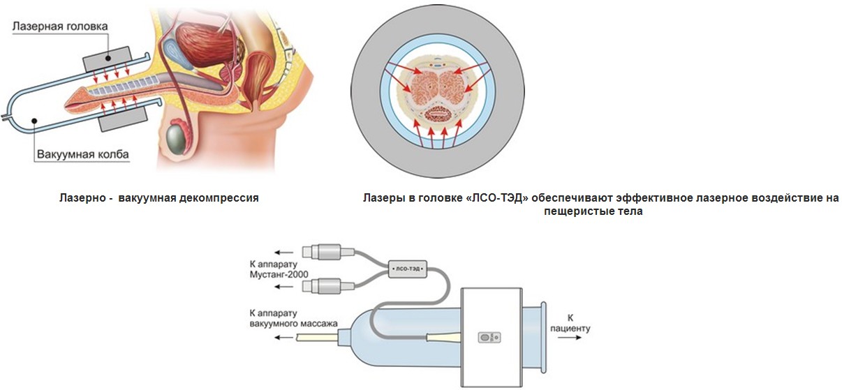 Аппаратный комплекс для терапии эректильной дисфункции МУСТАНГ-ТЭД